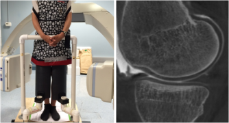 (Left) Acquisition set up in weight-bearing configuration using a C-arm CT. (Right) Sagittal slice of the reconstructed image of the knee. Thanks to contrast injection, the profile of femural and tibial cartilage is clearly visible.